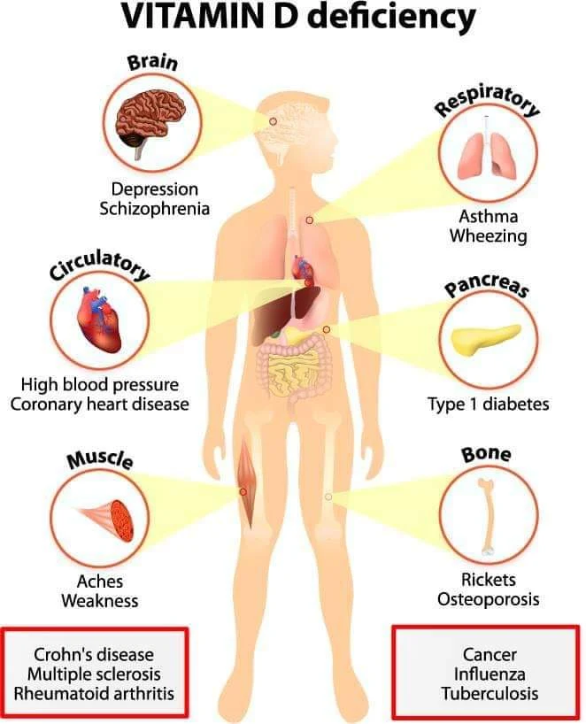 gejala kekurangan vitamin D-cara mengatasi kekurangan vitamin d,makanan vitamin d,kekurangan vitamin d boleh menyebabkan,defisiensi vitamin d pdf,insufisiensi vitamin d pada ibu