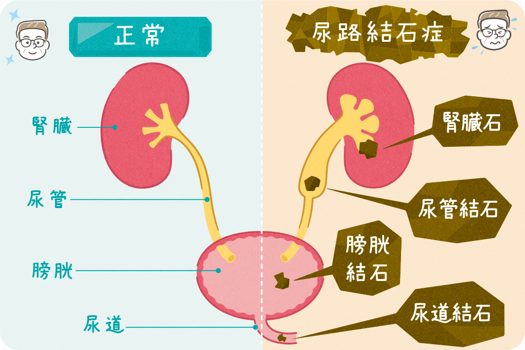 尿路結石症」。なりやすい人は？予防はできる？