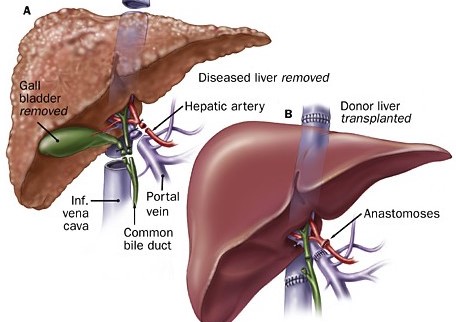  Menyembuhkan Kanker Hati Dengan Tanaman Herbal dan Aman