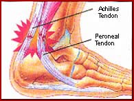 Ankle Tendonitis