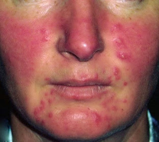 sign of,rosacea,causes,redness