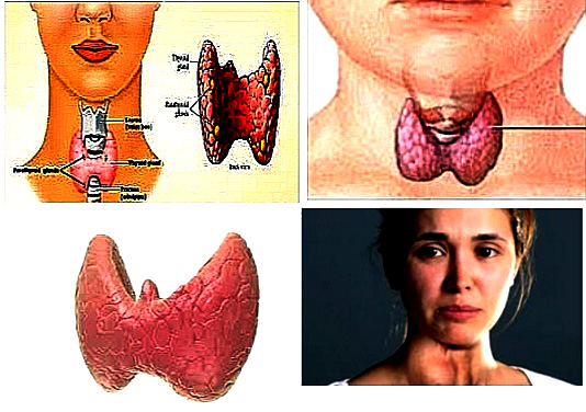 Thyroid disease.