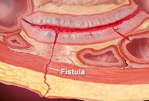 Treatment for Fistula