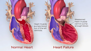 Gagal Jantung