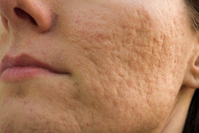 Como Eliminar Las Cicatrices De Acne