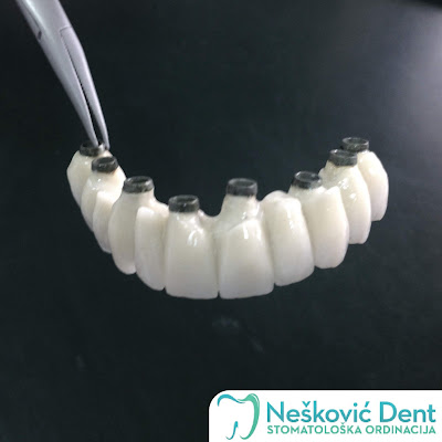 Zubni mostovi sa ugrađenim implantatima, zubarska ordinacija Nešković dent