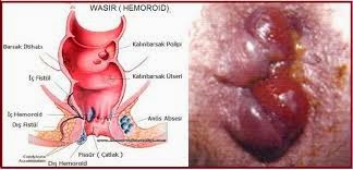 Hemoroid Atau Ambeien Hemoroid Atau Ambeien