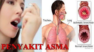 Penyakit Asma]