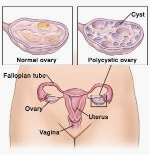  சினைப்பை நீர்க்கட்டிகள் Poly Cystic Ovarian Diseases / Syndrome சினைப்பையில் (Ovary) சிறு சிறு கட்டிகள் காணப்படும் நிலையை  சினைப்பை நீர்க்கட்டிகள் என்று கூறுவர். பெண்கள் கருத்தரிப்பதில் சிரமங்கள் ஏற்படுவது பரவலாக காணப்படுகிறது. இதற்கு சினைப்பை நீர்க்கட்டிகள் 10 சதவீதம் காரணமாக இருப்பதாக மருத்துவ ஆராய்ச்சி தகவல்கள் கூறுகின்றன. கருத்தரிக்க முடியாமல் போகும் பெண்கள் குடும்பத்திலும், சமூகத்திலும் நித்தமும் பல எண்ணற்ற போராட்டங்களை சந்திக்கின்றனர்.  சினைப்பை நீர்க்கட்டிகளை உடைய பெண்களுக்கு ஆண் இன ஹார்மோன்கள் மிக அதிகமாக சுரக்கின்றன. அதிலும் குறிப்பாக டெஸ்டோஸ்டிரான் (Testosterone) அதிகமாக சுரக்க ஆரம்பிக்கிறது. இதன் காரணமாக சினைமுட்டை முதிர்ச்சி அடைந்து வெளிவருவது தடைபடுகிறது.  இதில் பெரும்பாலும் இளம்பெண்களே அதிகமாக பாதிக்கப்படுகின்றனர். 15 முதல் 25 வயதுள்ள பெண்களுக்கு தற்போது அதிகமாக இந்நோய் உள்ளது.  பெரும்பாலும் 1முதல் 5 விழுக்காடு வரையிலான பெண்கள் பாதிக்கப்படுகின்றனர். இந்நோய் தற்காலத்தில் அதிகமாக ஏற்பட மனித வாழ்க்கையில் ஏற்பட்டுள்ள மாற்றங்களும் மன அழுத்தமும்(Stress & Depression) முக்கிய காரணமாக இருக்கிறது.   சினைப்பை நீர்க்கட்டிகள் உடைய பெண்களில் மாதந்தோறும் நிகழும் மாதவிலக்கு சுழற்சி (Menstrual Cycle) சரிவர இருக்காது. 2 - 3 மாதங்களுக்கு ஒருமுறை மாதவிலக்கு சுழற்சி நிகழும். சிலருக்கு மாதவிலக்கு குறைவாக வெளிப்படும்.  இவ்வாறு மாதவிலக்கு தள்ளிப்போவது (Amenorrhea) பல பிரச்சனைகளுக்கு வழிகோலுகிறது. உடல் எடை அதிகரிக்கிறது. ஆண்மைத் தன்மை பெண்களுக்கு மிகுதியாகிறது. ஆண்களைப் போல இவர்களுக்கு லேசாக முகத்தில் ரோமம் வளர ஆரம்பிக்கிறது. தேகத்திலும் ரோமங்கள் வளரும். சினைப்பைகள் அளவில் பெரிதாகும். சினைப்பை நீர்க் கட்டிகளில் நீர் சேர்வதே இதற்கு காரணமாகும்.  சினைப்பை நீர்க்கட்டிகள் உருவாக காரணங்கள் • நோயுண்டாக்கும் காரணத்தை அறுதியிட்டு கூற முடியுமா எனில் இயலாது என்றுதான் கூறவேண்டும். இந்நோய் பெரும்பாலும் பருவமடைந்த பெண்களிடயே காணப்படும் . எனினும் இதன் அறிகுறிகள் கருத்தரிக்கும் காலத்தில்தான் வெளியே தெரிய ஆரம்பிக்கிறது.  • மரபணு மூலமாகவும், பரம்பரையாகவும் இந்நோய் வரலாம். • ஹார்மோன்களின் (Hormonal Imbalance) ஏற்றத்தாழ்வுகளால் இந்நோய் உண்டாகிறது. சில சமயங்களில் அட்ரீனல் ஹார்மோன்கள் அதிகரித்துக் காணும்.   • டெஸ்டோஸ்டிரான் அதிகரித்துக் காணும்.  • புரோலாக்டின் (Prolactine) அதிகரித்துக் காணும்.  மாதவிடாய் கோளாறுகள் (Menstrual Disorders) ஒரு பெண் பூப்பெய்திய பின்(Menarche) முறையாக மாதந்தோறும் ஒழுங்காக மாதவிலக்கு உண்டாகும். இது இயல்பானது. ஆனால் இந்நோய் கண்ட சிலருக்கு மாதந்தோறும் மாதவிலக்கு நிகழாது. சில பெண்களில் மாதவிலக்கு ஏற்பட்டாலும் சினைமுட்டை வளர்ச்சியின்றி மாதவிடாய் நிகழும். இயல்பாக பெண்களில் மாதந்தோறும் சினைப்பையில் இருந்து ஒரு சினைமுட்டை வளர்ந்து வெளிப்படுகிறது.  0.5-1 மி.மீ. அளவிலான கட்டிகள் சினைப்பையில் ஓரத்தில் காணப்படும். பத்துக்கு மேற்பட்ட கட்டிகள் காணப்படும். 20 மி.மீ. அளவுக்கு மேல் கட்டிகள் பெரும்பாலும் பெரிதாவதில்லை. சினைப்பையின் மேற்பரப்பில் ஸ்கேன் சோதனையில் கட்டிகள் காணும். சினைப்பை அளவில் பெரிதாக காணப்படும்.  இந்நோயுற்ற பெண்களுக்கு உடல் எடை அதிகரிக்கும். இடுப்பு சுற்றளவு 35 அங்குலத்திற்கு அதிகமாக இருக்கும். உடல் எடை அதிகரிக்க ஆரம்பித்தவுடன் காரணத்தைக் கண்டறிந்து சிகிச்சை மேற்கொள்ளல் அவசியம்.  மலட்டுத் தன்மை (Infertility) சினைப்பை நீர்கட்டிகள் பெண்களுக்கு உண்டாகும் மலட்டுத் தன்மைக்கு 30% வரை காரணமாக இருக்கிறது. சாதாரணமாக கருத்தரிக்க இயலாமல் சிகிச்சைக்கு வரும் பெரும்பாலான பெண்களுக்கு இந்நோய் இருக்கிறது. இதற்கு சிகிச்சையளித்தாலே கருத்தரிக்கும் வாய்ப்பு அதிகரிக்கும்.  முடி வளர்ச்சி (Hirsutism – Hair Growth on Face and Body) பெரும்பாலும் பெண்களுக்கு முகத்திலும், உடலிலும் அதிகளவில் முடிகள் இருப்பதில்லை. இந்நோயால் பாதிக்கப்பட்ட பெண்களுக்கு ஆண்களைப் போல அதிக முடிவளர்ச்சி உடலில் உண்டாகும்.  குறிப்பாக மேலுதடு, கீழ்தாடை, மார்பு, முதுகு, அடிவயிறு, தொடை, முன்கைகளில் முடி வளர்ச்சி காணப்படும். தோலில் காணப்படும் மாற்றங்கள்.  உடலில் சில இடங்களில் கருமை நிறம் (Hyperpigmentation) அதிகரித்து காணும்.  பெரும்பாலும் கழுத்து, தொடையின் உட்பகுதி, அக்குள் பகுதிகளில் இம்மாற்றம் காணப்படுகிறது.  ஆய்வுகூடத் தேர்வுகள் (Lab Investigations) • ஸ்கேன் (USG Pelvis) பரிசோதனை செய்வதன் மூலம் சினைப்பை நீர்க்கட்டிகளை உறுதிப்படுத்தலாம். • ஹார்மோன்களின் அளவுகளை பரிசோதனை செய்வதன் மூலமும் கண்டறியலாம்.  மருத்துவம் மற்றும் ஆலோசனைகள் சினைப்பை நீர்க்கட்டிகள் இருக்கின்றன என்பதை சூதகதடை, உடல் எடை அதிகரித்தல் போன்ற அறிகுணங்களைக் கொண்டு யூகிக்கும்போது அல்லது மருத்துவப் பரிசோதனையில் கண்டுபிடிக்கும்போது பெண்கள் செய்யவேண்டிய முதற் காரியம் அவர்களது உடல் எடையை குறைக்கும் நடவடிக்கைகளில் இறங்குவதேயாகும்.  உடல் எடையை குறைத்தல் - Weight Loss தினமும் காலை அல்லது மாலை வேளையில் 3 முதல் 5 கி.மீ தொலைவு வரை நடைபயிற்சி மேற்கொள்ளலாம். நடைபயிற்சி மேற் கொள்வதால் உடலிலுள்ள தேவையற்ற கொழுப்புகள் கரைய ஆரம்பிக்கின்றன. நடைபயிற்சி மூலம் ஒரு மாத காலத்திலேயே நல்ல பலனை அடையலாம்.  நடை பயிற்சியுடன் உணவு கட்டுப்பாட்டை பின்பற்ற வேண்டும். அதிக கொழுப்பு மிக்க பால் பொருட்கள், சாக்லேட், ஐஸ்கிரீம், ஆட்டிறைச்சி, எண்ணெயில் பொரித்த பலகாரங்கள், இனிப்பு வகைகளை குறைத்துக்கொள்ள வேண்டும்.  இயற்கை உணவுகளான காய்கறி, கீரை இவற்றை அதிகம் சாப்பிட வேண்டும்.   புகைப்பிடிக்கும் பெண்களாக இருந்தால் அந்த பழக்கத்தை அறவே விடவேண்டும். புகைப் பிடிப்பதால் ஹார்மோன் அளவுகளில் மாற்றம் ஏற்படுகிறது.  முடிகளை நீக்குவதற்கு பல வழிகள் இருக்கிறது. சவரம் செய்தல், பிளீச்சிங் செய்தல், வாக்சிங் செய்தல் போன்ற முறைகளை கையாளுவதற்கு முன்பு மருத்துவரின் ஆலோசனையை நாடவேண்டியது அவசியம். எலக்ரோலைசிஸ் மற்றும் லேசர் முறையில் தற்போது முடிகளை சிறப்பாக நீக்குகின்றனர். ஆனால் செலவு அதிகம்.  தகுந்த சிகிச்சை மூலம் கருத்தரிக்கும் வாய்ப்பு கண்டிப்பாக உண்டாகும் என்பதால் சினைப்பை நீர்க்கட்டிகள் உள்ளவர்கள் மருத்துவர் ஆலோசனையை நாடுவது இன்றியமையாத தாகும்.   மாதவிடாய் சீராக சினைமுட்டை முதிர்ச்சியடைந்து வெளிப்படுதலைத் தூண்ட ஆங்கில மருத்துவர்கள் ஹார்மோன் சிகிச்சை அளிக்கின்றனர். பொதுவாக இம்மாதிரியான சிகிச்சையால் பக்க விளைவுகள் ஏற்பட வாய்ப்புண்டு என்பதை மறுப்பதிற்கில்லை. எனவே சினைப்பை நீர்க்கட்டிகளுக்கு ஏற்ற மருத்துவம் ஹோமியோபதி மருத்துவமே என்று கூறலாம். நோயின் அறிகுறிகளுக்கேற்ற மருந்துகள் என்ற அடிப்படையில் சிகிச்சை அளிக்கப்படுவதால் பக்க விளைவுகளின்றி அறுவை சிகிச்சையின்றி சினைப்பை நீர்க்கட்டிகளை கரைக்கலாம். சினைப்பை நீர்க்கட்டிகள் கரைய தொடங்குகின்ற போதே சினைமுட்டைகள் முதிர்ச்சியடைந்து வெளிப்படும் சூழல் உருவாகிறது.      சினைப்பை நீர்க்கட்டிகள் Poly Cystic Ovarian Diseases / Syndrome சிகிச்சைக்கு தொடர்பு கொள்ளவும் சிறப்பு மருத்துவர் செந்தில் குமார் தண்டபாணி அவர்களிடம் இதைப்போன்ற சினைப்பை நீர்க்கட்டிகள் Poly Cystic Ovarian Diseases / Syndrome பிரச்சினைகளுக்கு அலோசனை &  சிகிச்சை பெற்று பலர் நல்ல பலனடைந்திருக்கிறார்கள். மருத்துவர் செந்தில் குமார் அவர்களை சென்னை, வேளச்சேரி விவேகானந்தா ஹோமியோபதி கிளினிக் & உளவியல் ஆலோசனை மையத்தில் சந்திக்கலாம். முன்பதிவு அவசியம். முன்பதிவிற்கு தொடர்புகொள்ளவும் 9786901830, மின் அஞ்சல்: consult.ur.dr@gmail.com    மேலும் விபரங்களுக்கும் ஆலோசனைக்கும் சிகிச்சைக்கும் தொடர்பு கொள்க விவேகானந்தா கிளினிக் ஆலோசனை மையங்கள் & தொடர்பு எண்கள் சென்னை:- 9786901830  பண்ருட்டி:- 9443054168  புதுச்சேரி:- 9865212055 (Camp) மின் அஞ்சல் : consult.ur.dr@gmail.com, homoeokumar@gmail.com   முன்பதிவிற்கு அழைக்கவும் அல்லது மின் அஞ்சல் அனுப்பவும்.  முன்பதிவிற்கு: உங்களின் பெயர் - வயது – அலைபேசி எண் – பிரச்சனை (ஒரு வரியில்) தேதி – கிழமை – இடம், முதலியவற்றை குறுந்தகவல் மூலம் அனுப்பவும்.  உதாரணம்: ரம்யா - 28 – 99******00 – PCOD – 20-12-2013 – சனிக்கிழமை – சென்னை, மருத்துவர் உங்களின் முன்பதிவை குறுந்தகவல் மூலம் உறுதிப்படுத்துவார்.