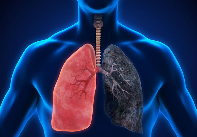 Lung cancer