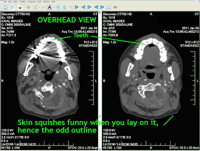 CRT image of skull and neck cervical vertebrae and sarcoma tumor