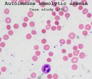 Case study (35) - Autoimmune hemolytic anemia