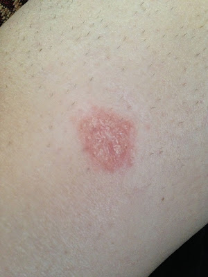 Red Bumps On Legs Wallpapers HD 1