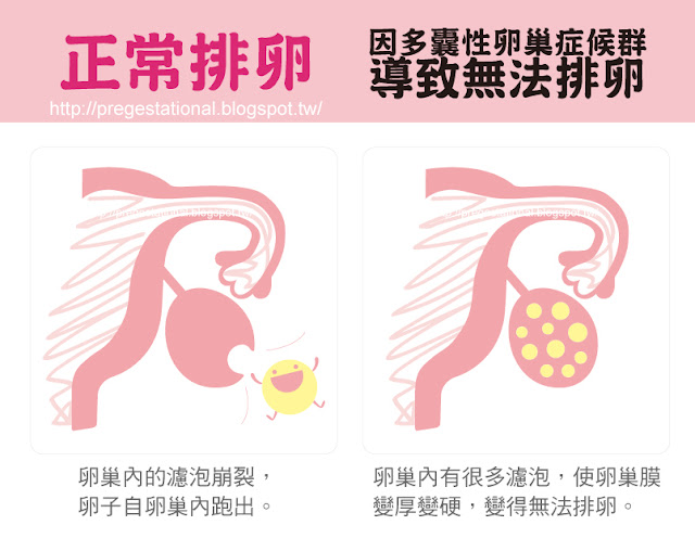 多囊性卵巢症(PCOS)是什麼？