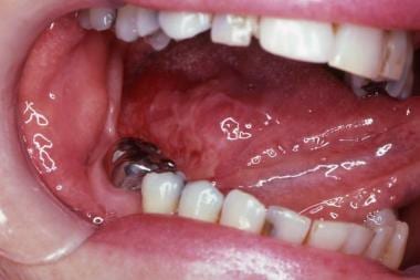 mouth cancer symptoms.