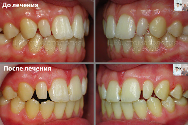 Аномалии размера  зубов. Лечение брекетами