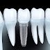 Cấy ghép răng implant khi nào