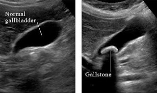 https://drmdnasir.blogspot.com/?m=1, gallbladder stone