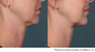 Dr. Karron Power discusses Kybella and other double chin treatments on ABC News