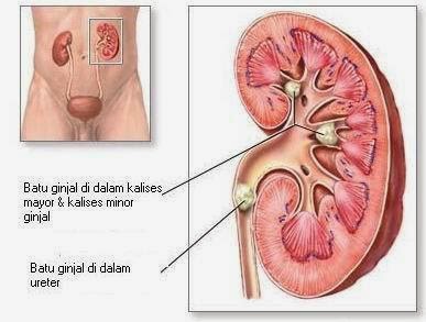 Pencegahan Batu Ginjal yang Bisa Anda Lakukan Sejak Dini