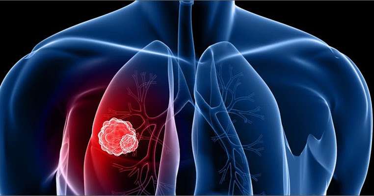  Cara  Mengatasi Penyakit  Cara  Mengobati  Kanker Paru  paru  