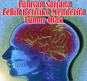 Ternyata Lulusan Sarjana Lebih Berisiko Menderita Tumor Otak