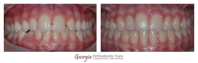 Orthodontic Treatment of Double Maxillary Canine Impaction in the Palate, Georgia Orthodontic Care