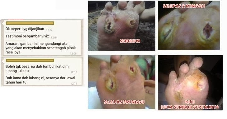 Ubat Kaki Luka Kencing Manis - Rasmi W