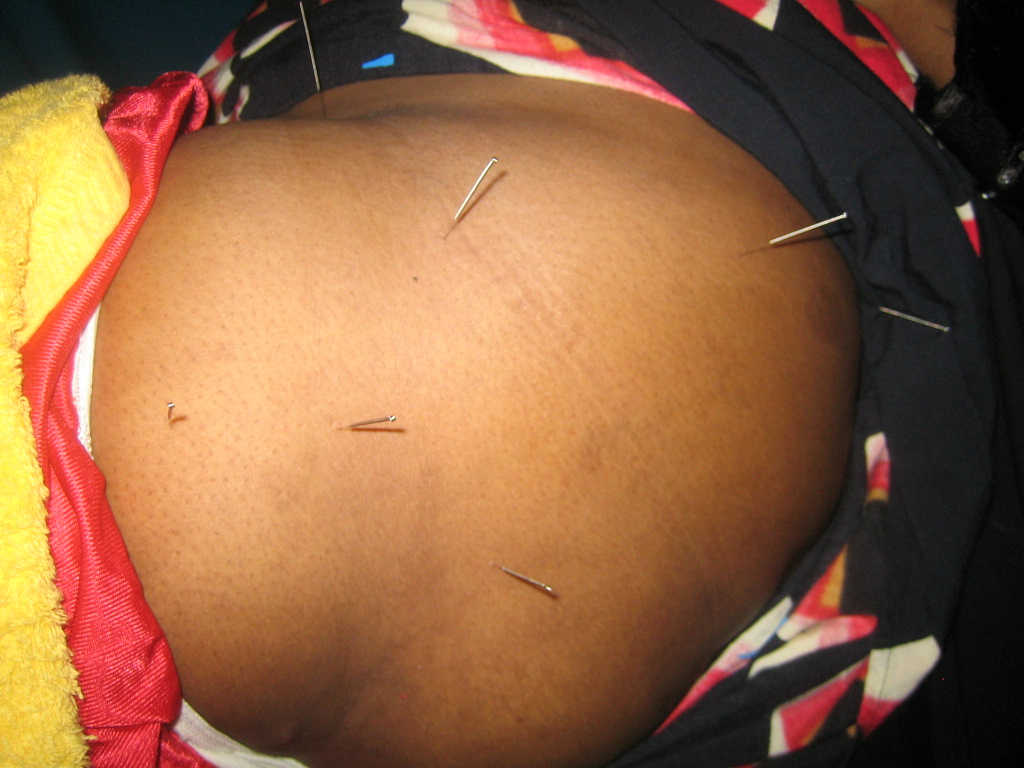 Acupuncture & Alternative Treatment: How Acupuncture Works