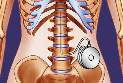 Intrathecal pumps are frequently used in the treatment of chronic pain patients with no or little side effects.