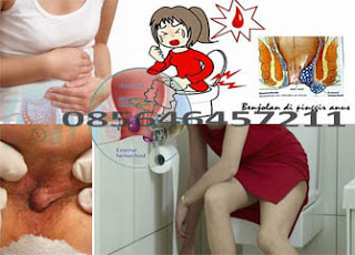 Obat Wasir AmbeJOSS Hd 500mg Apotik Online