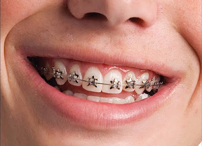 Có cần nhổ răng khi niềng răng?