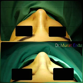 Micromotor Assisted Rhinoplasty, Nose Job Istanbul,Female Nose Aesthetic Turkey,