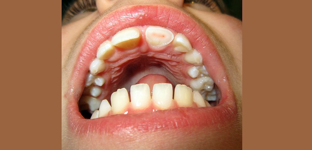 Traumatismo Dentário