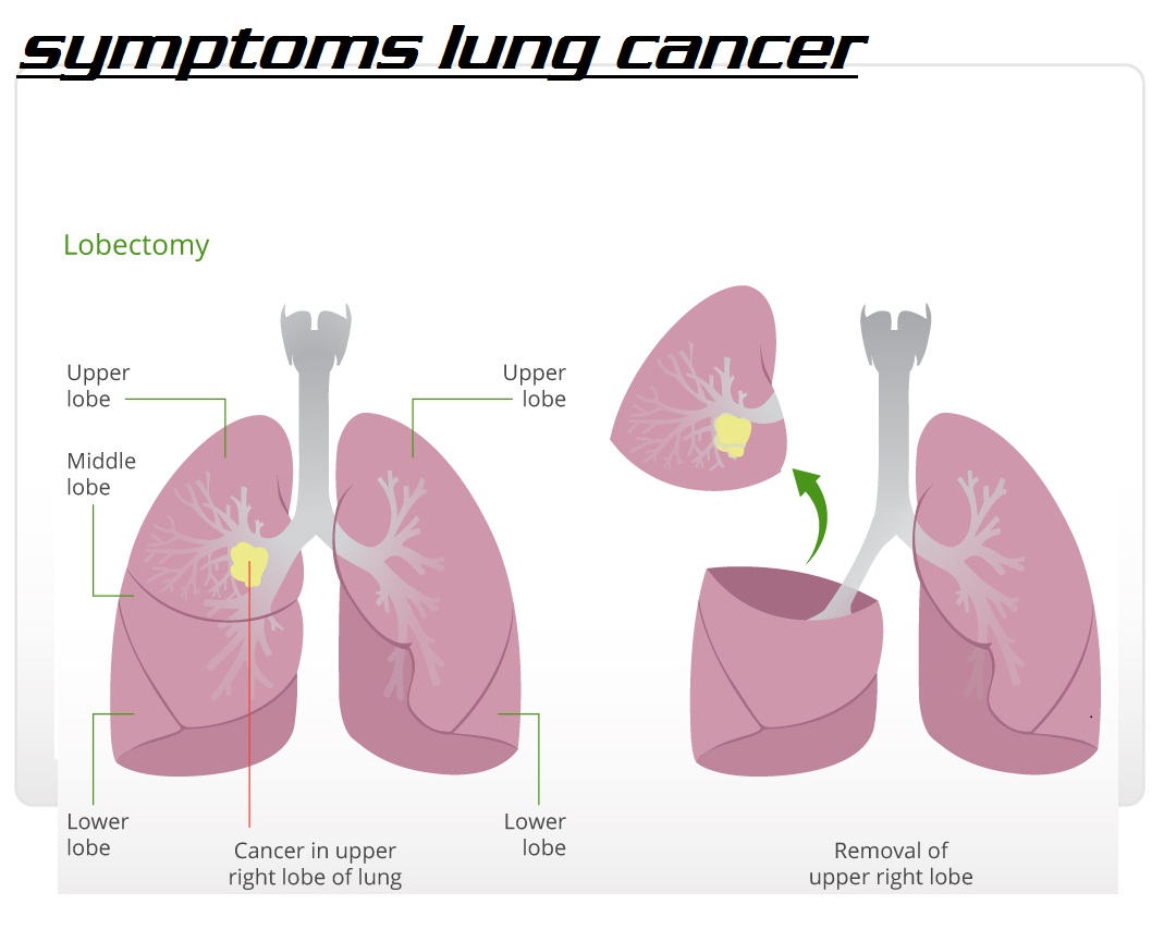 image lung cancer symptoms | picture of lung cancer | cancer in upper 