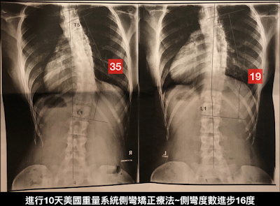 脊椎側彎運動, 脊椎側彎治療,脊椎側彎重量系統訓練,美國CLEAR Institute療法