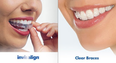 Kĩ thuật niềng răng không mắc cài 3D Clear 