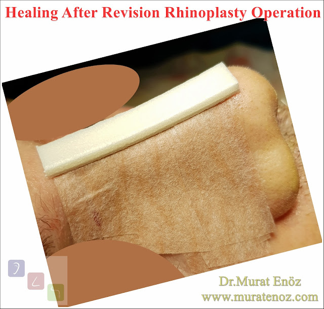 Revision nose aesthetic surgery - Secondary rhinoplasty - Revision nose job in Istanbul - Secondary nose job in Turkey - Secondary nose cosmetic surgery - Tertiary rhinoplasty - Secondary rhinoplasty challenges - Revision rhinoplasty using rib cartilage - Polly beak deformity - Cost of Revision Rhinoplasty in Istanbul - Healing After Revision Rhinoplasty Operation