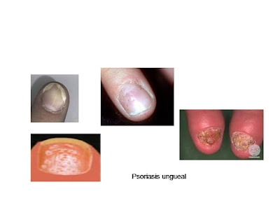 Psoriasis ungueal