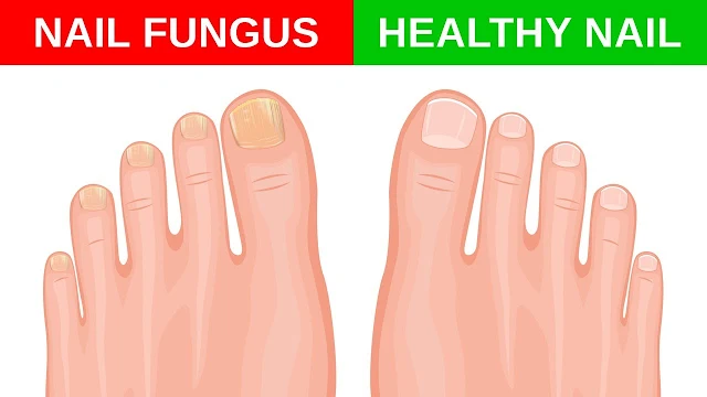 4 Simple And Effective Remedies To Treat Nail Fungus At Home Naturally