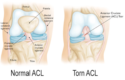 PENGAMBILAN MINYAK ZAITUN UNTUK MASALAH LIGAMEN TERKOYAK. I Aafiyat Lifestyle