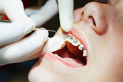 Tác hại của việc niềng răng sai kỹ thuật
