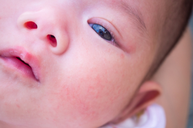 Understanding and Preventing Baby Acne Causes and Strategies