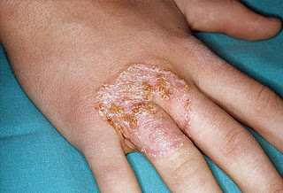 Bintik Yang Terasa Gatal Di Lengan Dan Kaki Karena Impetigo (Infeksi Bakteri)