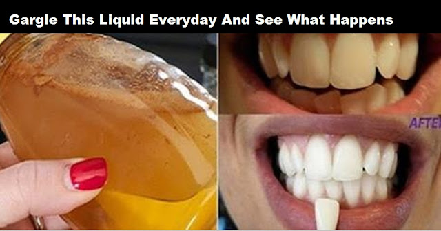 Health : Gargle This Liquid Eeveryday And See What Happens to Your Teeth Amazing!!