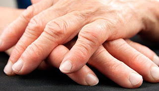 Reumatismo en la mano Síntomas y Cura