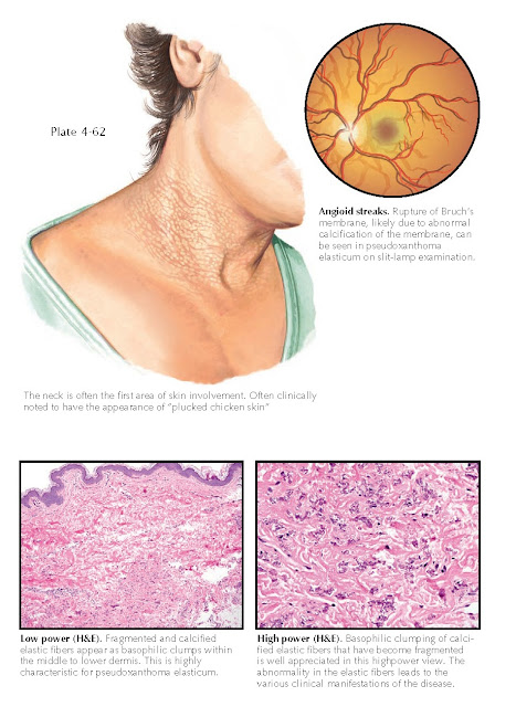 PSEUDOXANTHOMA ELASTICUM