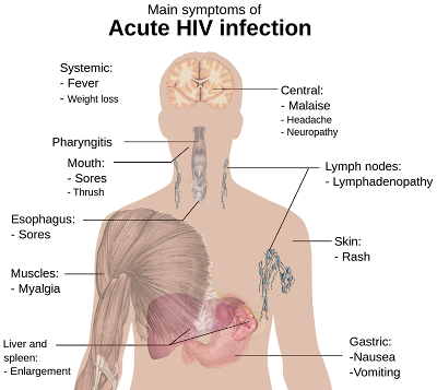 Hepatitis C a form of hepatitis liver inflammation that is caused by a virus known on the street as HCV.