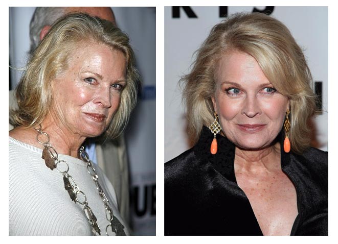 fergie plastic surgery before and after. Candice Bergen Plastic Surgery