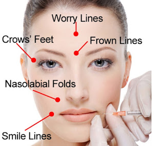 botox injection cost